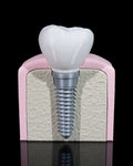 3D Printed Dental Implant Model Educational Human Anatomy Science STEM School image 0