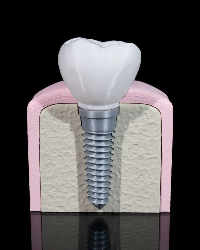 3D Printed Dental Implant Model Educational Dentistry Anatomy STEM Science image 0
